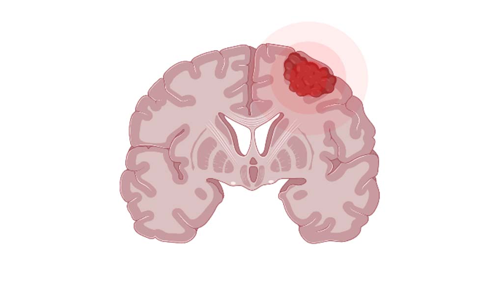 Nieuwe CPoC-subsidie toegekend: GLOW – GLioblastoma targeted treatment Option maximisation by WGS